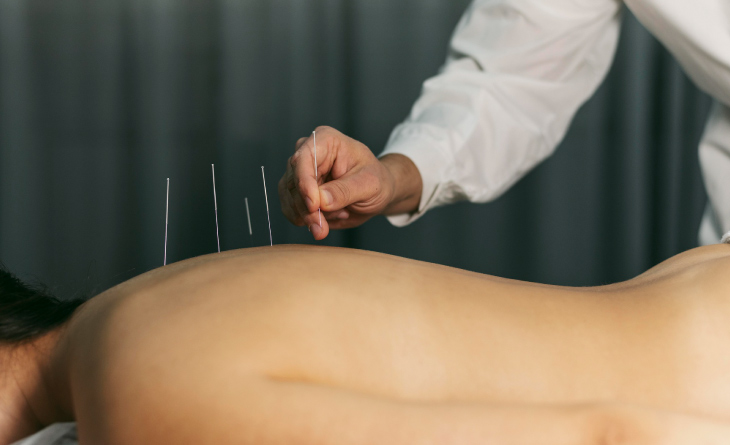 Descubra os Benefícios da Acupuntura Auricular para o Bem-Estar