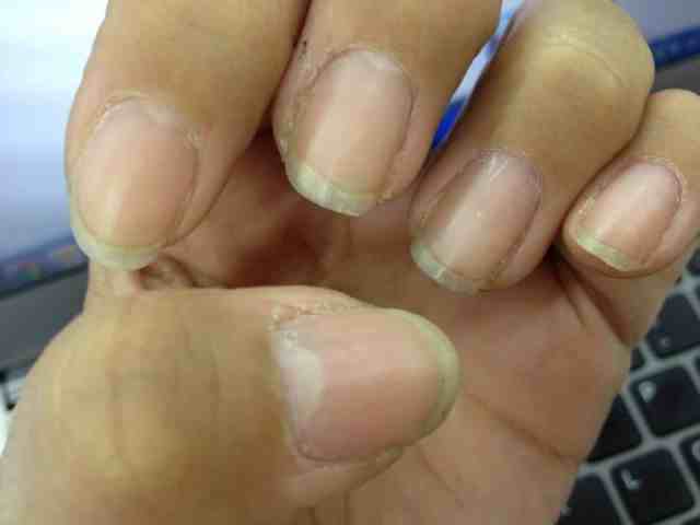 cuticula ressecada o que passar