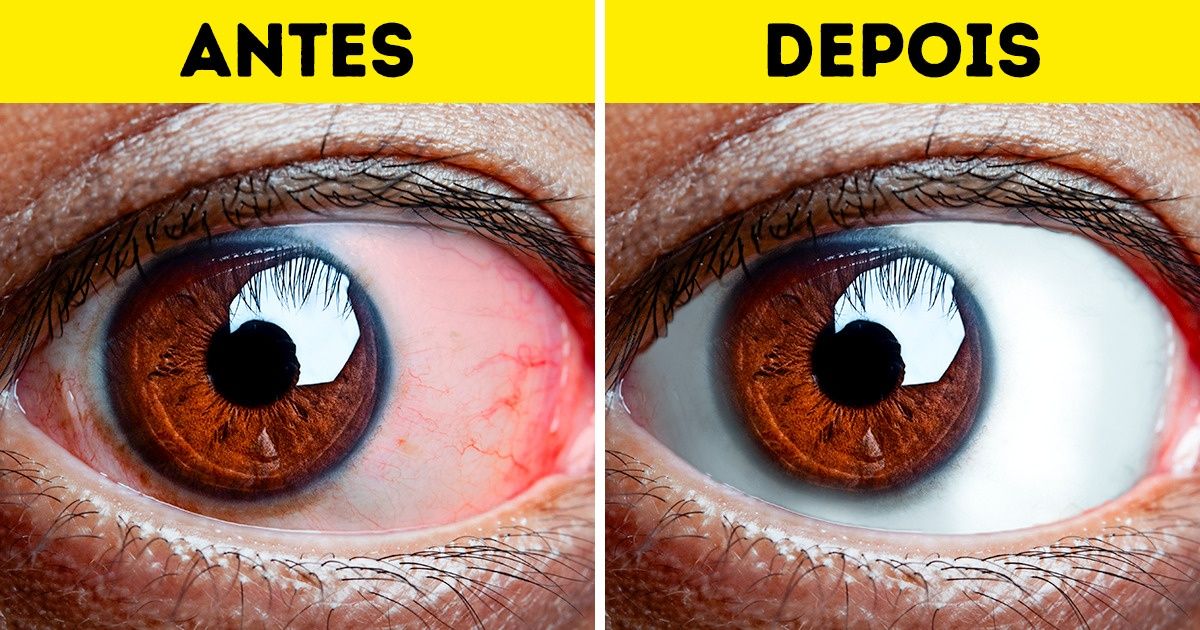 melhores exercícios para relaxar os olhos cansados
